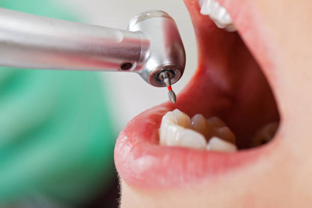 Best Emergency Root Canal Therapy in South Gate Ridge, FL